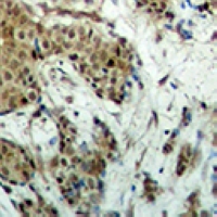 MECOM / EVI1 Antibody - Immunohistochemical analysis of EVI1 staining in human breast cancer formalin fixed paraffin embedded tissue section. The section was pre-treated using heat mediated antigen retrieval with sodium citrate buffer (pH 6.0). The section was then incubated with the antibody at room temperature and detected using an HRP conjugated compact polymer system. DAB was used as the chromogen. The section was then counterstained with hematoxylin and mounted with DPX.