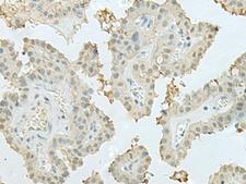 MECOM / EVI1 Antibody - Immunohistochemistry of paraffin-embedded Human thyroid cancer tissue  using MECOM Polyclonal Antibody at dilution of 1:60(×200)
