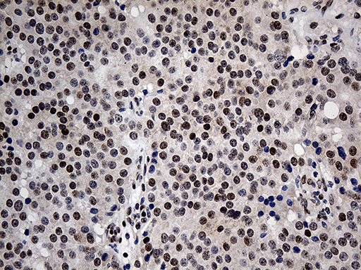 MECP2 Antibody - Immunohistochemical staining of paraffin-embedded Carcinoma of Human pancreas tissue using anti-MECP2 mouse monoclonal antibody. (Heat-induced epitope retrieval by 1mM EDTA in 10mM Tris buffer. (pH8.5) at 120°C for 3 min. (1:150)