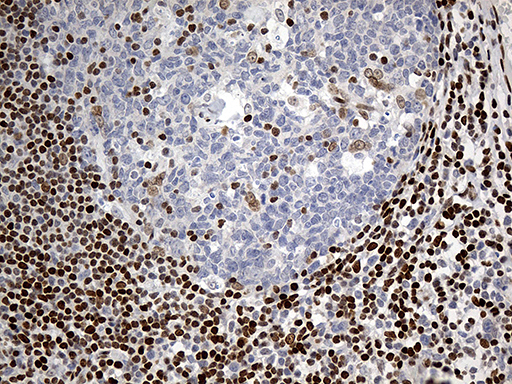MECP2 Antibody - Immunohistochemical staining of paraffin-embedded Human tonsil within the normal limits using anti-MECP2 mouse monoclonal antibody. (Heat-induced epitope retrieval by 1mM EDTA in 10mM Tris buffer. (pH8.5) at 120°C for 3 min. (1:150)