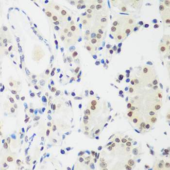 MECP2 Antibody - Immunohistochemistry of paraffin-embedded human stomach cancer tissue.