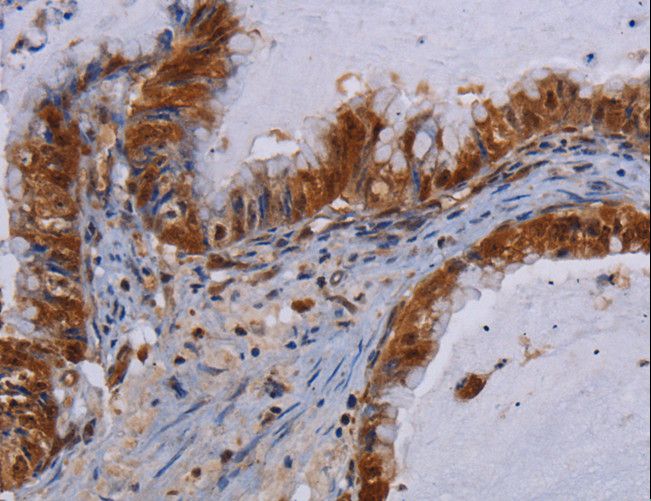 MECP2 Antibody - Immunohistochemistry of paraffin-embedded Human esophagus cancer using MECP2 Polyclonal Antibody at dilution of 1:60.