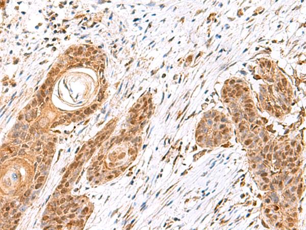 MECR Antibody - Immunohistochemistry of paraffin-embedded Human esophagus cancer tissue  using MECR Polyclonal Antibody at dilution of 1:60(×200)