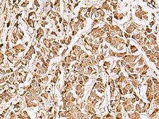 MECR Antibody - Immunohistochemistry of paraffin-embedded Human breast cancer tissue  using MECR Polyclonal Antibody at dilution of 1:70(×200)
