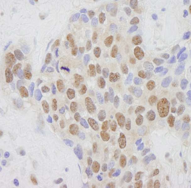 MED1 / TRAP220 Antibody - Detection of Human CRSP1(TRAP220) by Immunohistochemistry. Sample: FFPE section of human breast tumor. Antibody: Affinity purified rabbit anti-CRSP1(TRAP220) used at a dilution of 1:250.