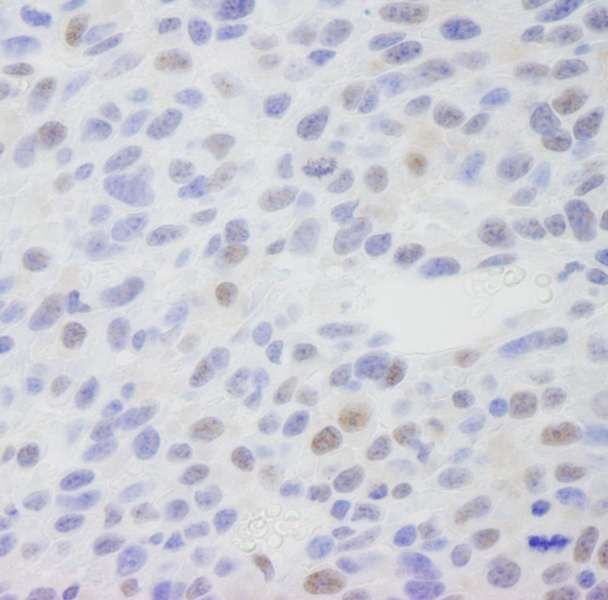 MED1 / TRAP220 Antibody - Detection of Mouse CRSP1(TRAP220) by Immunohistochemistry. Sample: FFPE section of mouse squamous cell carcinoma. Antibody: Affinity purified rabbit anti-CRSP1(TRAP220) used at a dilution of 1:250.