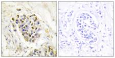 MED1 / TRAP220 Antibody - Peptide - + Immunohistochemistry analysis of paraffin-embedded human breast carcinoma tissue using MED1 antibody.