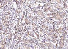MED1 / TRAP220 Antibody - 1:100 staining human breast carcinoma tissue by IHC-P. The tissue was formaldehyde fixed and a heat mediated antigen retrieval step in citrate buffer was performed. The tissue was then blocked and incubated with the antibody for 1.5 hours at 22°C. An HRP conjugated goat anti-rabbit antibody was used as the secondary.
