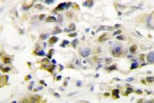 MED1 / TRAP220 Antibody - IHC of TRAP220 (P697) pAb in paraffin-embedded human breast carcinoma tissue.