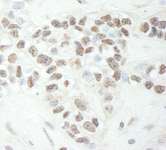 MED12 Antibody - Detection of Human MED12 by Immunohistochemistry. Sample: FFPE section of human breast carcinoma. Antibody: Affinity purified rabbit anti-MED12 used at a dilution of 1:1000 (1 Detection: DAB.