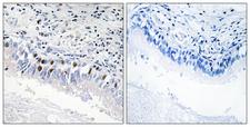 MED12 Antibody - Immunohistochemistry analysis of paraffin-embedded human lung carcinoma, using MED12 Antibody. The picture on the right is blocked with the synthesized peptide.