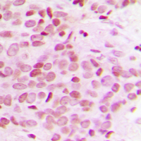 MED12 Antibody - Immunohistochemical analysis of TRAP230 staining in human breast cancer formalin fixed paraffin embedded tissue section. The section was pre-treated using heat mediated antigen retrieval with sodium citrate buffer (pH 6.0). The section was then incubated with the antibody at room temperature and detected using an HRP conjugated compact polymer system. DAB was used as the chromogen. The section was then counterstained with hematoxylin and mounted with DPX.