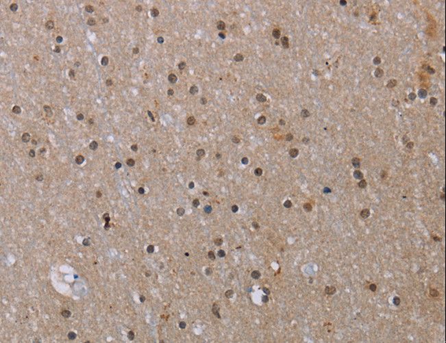 MED12 Antibody - Immunohistochemistry of paraffin-embedded Human liver cancer using MED12 Polyclonal Antibody at dilution of 1:40.