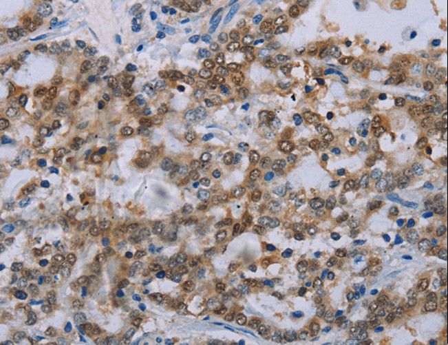 MED12 Antibody - Immunohistochemistry of paraffin-embedded Human liver cancer using MED12 Polyclonal Antibody at dilution of 1:40.