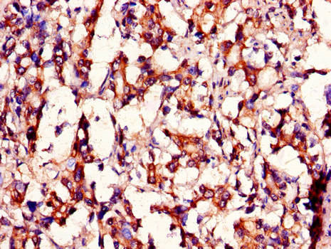 MED12 Antibody - Immunohistochemistry of paraffin-embedded human gastric cancer using MED12 Antibody at dilution of 1:100