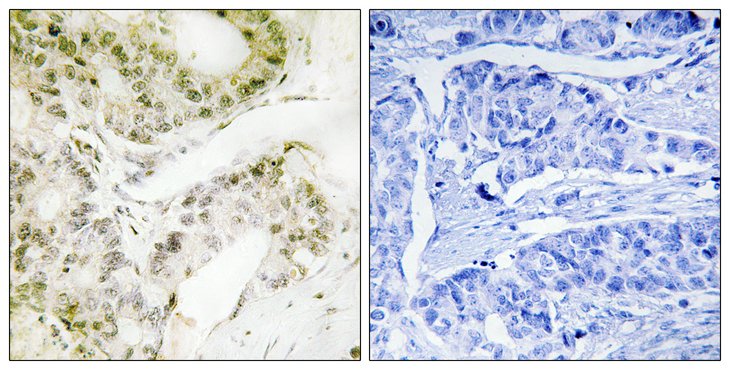MED13 / TRAP240 Antibody - Immunohistochemistry analysis of paraffin-embedded human lung carcinoma, using MED13 Antibody. The picture on the right is blocked with the synthesized peptide.