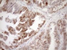 MED15 / ARC105 Antibody - Immunohistochemical staining of paraffin-embedded Adenocarcinoma of Human ovary tissue using anti-MED15 mouse monoclonal antibody. (Heat-induced epitope retrieval by 1mM EDTA in 10mM Tris buffer. (pH8.5) at 120°C for 3 min. (1:150)