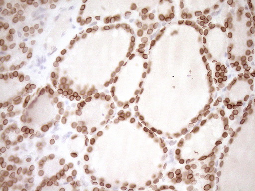 MED15 / ARC105 Antibody - Immunohistochemical staining of paraffin-embedded Human thyroid tissue within the normal limits using anti-MED15 mouse monoclonal antibody. (Heat-induced epitope retrieval by 1mM EDTA in 10mM Tris buffer. (pH8.5) at 120°C for 3 min. (1:150)
