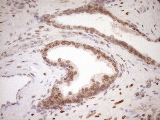 MED15 / ARC105 Antibody - Immunohistochemical staining of paraffin-embedded Carcinoma of Human prostate tissue using anti-MED15 mouse monoclonal antibody. (Heat-induced epitope retrieval by 1mM EDTA in 10mM Tris buffer. (pH8.5) at 120°C for 3 min. (1:150)
