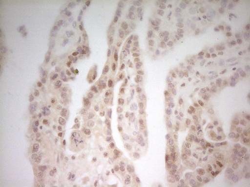 MED15 / ARC105 Antibody - Immunohistochemical staining of paraffin-embedded Adenocarcinoma of Human ovary tissue using anti-MED15 mouse monoclonal antibody. (Heat-induced epitope retrieval by 1 mM EDTA in 10mM Tris, pH8.5, 120C for 3min,