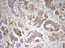MED15 / ARC105 Antibody - Immunohistochemical staining of paraffin-embedded Adenocarcinoma of Human ovary tissue using anti-MED15 mouse monoclonal antibody. (Heat-induced epitope retrieval by 1 mM EDTA in 10mM Tris, pH8.5, 120C for 3min,