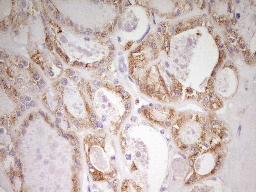 MED15 / ARC105 Antibody - Immunohistochemical staining of paraffin-embedded Carcinoma of Human thyroid tissue using anti-MED15 mouse monoclonal antibody. (Heat-induced epitope retrieval by 1 mM EDTA in 10mM Tris, pH8.5, 120C for 3min,