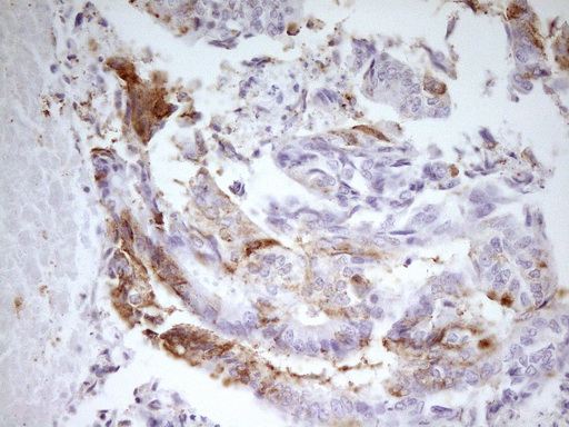 MED15 / ARC105 Antibody - Immunohistochemical staining of paraffin-embedded Adenocarcinoma of Human colon tissue using anti-MED15 mouse monoclonal antibody. (Heat-induced epitope retrieval by 1 mM EDTA in 10mM Tris, pH8.5, 120C for 3min,