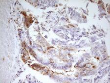 MED15 / ARC105 Antibody - IHC of paraffin-embedded Adenocarcinoma of Human colon tissue using anti-MED15 mouse monoclonal antibody. (Heat-induced epitope retrieval by 1 mM EDTA in 10mM Tris, pH8.5, 120°C for 3min).