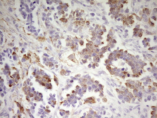 MED15 / ARC105 Antibody - IHC of paraffin-embedded Adenocarcinoma of Human ovary tissue using anti-MED15 mouse monoclonal antibody. (Heat-induced epitope retrieval by 1 mM EDTA in 10mM Tris, pH8.5, 120°C for 3min).