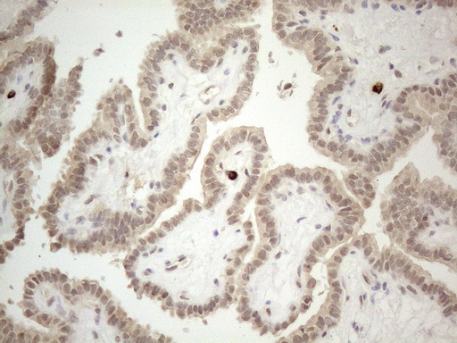 MED15 / ARC105 Antibody - Immunohistochemical staining of paraffin-embedded Carcinoma of Human thyroid tissue using anti-MED15 mouse monoclonal antibody. (Heat-induced epitope retrieval by 1mM EDTA in 10mM Tris buffer. (pH8.5) at 120°C for 3 min. (1:150)