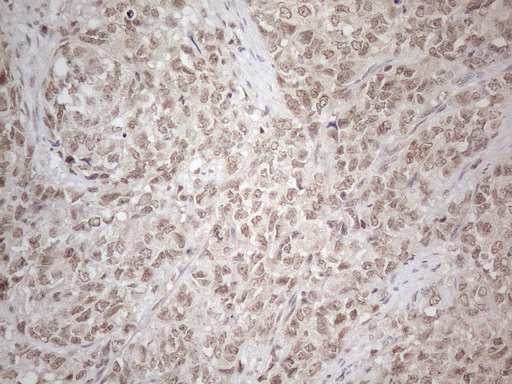 MED15 / ARC105 Antibody - Immunohistochemical staining of paraffin-embedded Adenocarcinoma of Human endometrium tissue using anti-MED15 mouse monoclonal antibody. (Heat-induced epitope retrieval by 1mM EDTA in 10mM Tris buffer. (pH8.5) at 120°C for 3 min. (1:150)