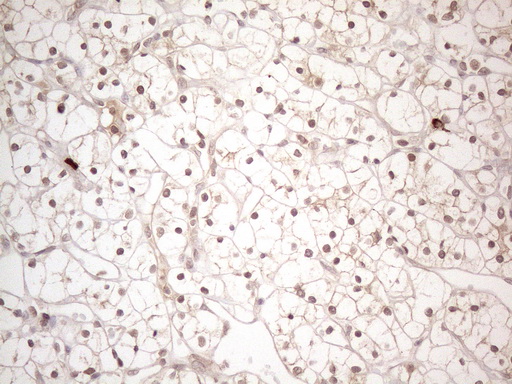 MED15 / ARC105 Antibody - Immunohistochemical staining of paraffin-embedded Carcinoma of Human kidney tissue using anti-MED15 mouse monoclonal antibody. (Heat-induced epitope retrieval by 1mM EDTA in 10mM Tris buffer. (pH8.5) at 120°C for 3 min. (1:150)