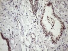 MED15 / ARC105 Antibody - Immunohistochemical staining of paraffin-embedded Carcinoma of Human prostate tissue using anti-MED15 mouse monoclonal antibody. (Heat-induced epitope retrieval by 1mM EDTA in 10mM Tris buffer. (pH8.5) at 120 oC for 3 min. (1:150)