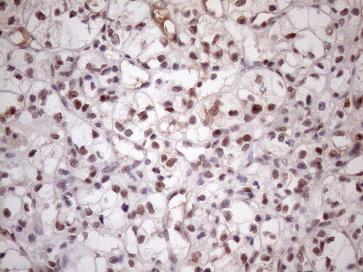 MED15 / ARC105 Antibody - Immunohistochemical staining of paraffin-embedded Carcinoma of Human kidney tissue using anti-MED15 mouse monoclonal antibody. (Heat-induced epitope retrieval by 1mM EDTA in 10mM Tris buffer. (pH8.5) at 120 oC for 3 min. (1:150)