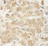 MED15 / ARC105 Antibody - Detection of Human MED15 by Immunohistochemistry. Sample: FFPE section of human breast carcinoma. Antibody: Affinity purified rabbit anti-MED15 used at a dilution of 1:250.