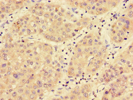 MED17 / TRAP80 Antibody - Immunohistochemistry of paraffin-embedded human liver cancer using MED17 Antibody at dilution of 1:100