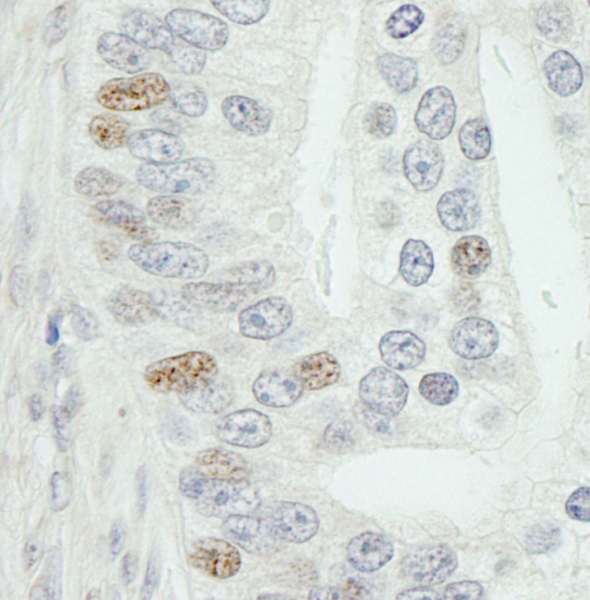 MED18 Antibody - Detection of Human MED18 by Immunohistochemistry. Sample: FFPE section of human prostate adenocarcinoma. Antibody: Affinity purified rabbit anti-MED18 used at a dilution of 1:250.