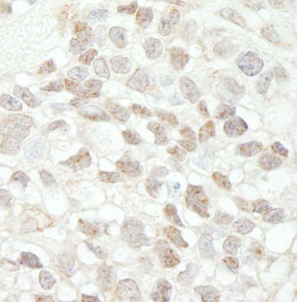 MED18 Antibody - Detection of Human MED18 by Immunohistochemistry. Sample: FFPE section of human breast carcinoma. Antibody: Affinity purified rabbit anti-MED18 used at a dilution of 1:200 (1 ug/ml). Detection: DAB.