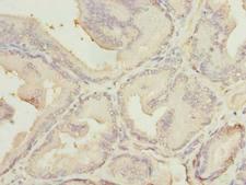MED18 Antibody - Immunohistochemistry of paraffin-embedded human prostate cancer using antibody at dilution of 1:100.