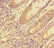MED20 Antibody - Immunohistochemistry of paraffin-embedded human colon cancer at dilution 1:100