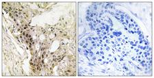 MED21 Antibody - Peptide - + Immunohistochemistry analysis of paraffin-embedded human breast carcinoma tissue, using MED21 antibody.