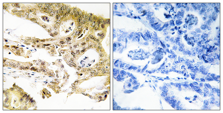 MED23 / SUR2 Antibody - Immunohistochemistry analysis of paraffin-embedded human colon carcinoma tissue, using MED23 Antibody. The picture on the right is blocked with the synthesized peptide.