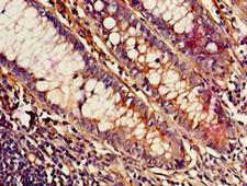 MED23 / SUR2 Antibody - Immunohistochemistry of paraffin-embedded human colon cancer using MED23 Antibody at dilution of 1:100