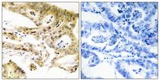 MED23 / SUR2 Antibody - Peptide - + Immunohistochemistry analysis of paraffin-embedded human colon carcinoma tissue, using MED23 antibody.