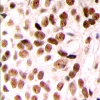 MED23 / SUR2 Antibody - Immunohistochemical analysis of SUR2 staining in human breast cancer formalin fixed paraffin embedded tissue section. The section was pre-treated using heat mediated antigen retrieval with sodium citrate buffer (pH 6.0). The section was then incubated with the antibody at room temperature and detected with HRP and DAB as chromogen. The section was then counterstained with hematoxylin and mounted with DPX.