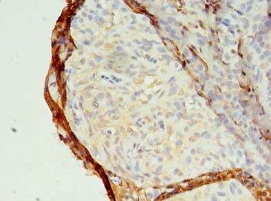MED28 / Magicin Antibody - Immunohistochemistry of paraffin-embedded human breast cancer using antibody at dilution of 1:100.
