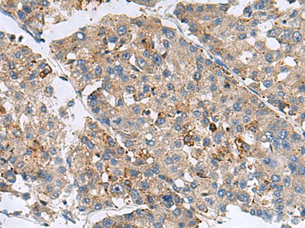 MED31 Antibody - Immunohistochemistry of paraffin-embedded Human liver cancer tissue  using MED31 Polyclonal Antibody at dilution of 1:100(×200)