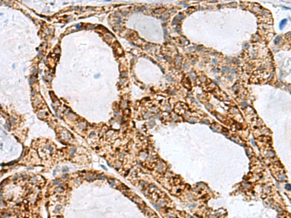 MED31 Antibody - Immunohistochemistry of paraffin-embedded Human thyroid cancer tissue  using MED31 Polyclonal Antibody at dilution of 1:100(×200)