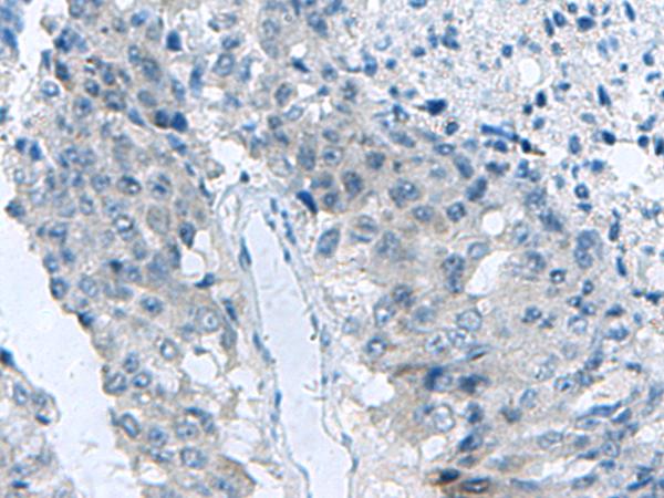 MED31 Antibody - Immunohistochemistry of paraffin-embedded Human liver cancer tissue  using MED31 Polyclonal Antibody at dilution of 1:140(×200)