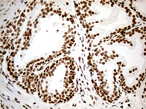 MED9 Antibody - Immunohistochemical staining of paraffin-embedded Carcinoma of Human prostate tissue using anti-MED9 mouse monoclonal antibody. (Heat-induced epitope retrieval by 1mM EDTA in 10mM Tris buffer. (pH8.5) at 120°C for 3 min. (1:1000)